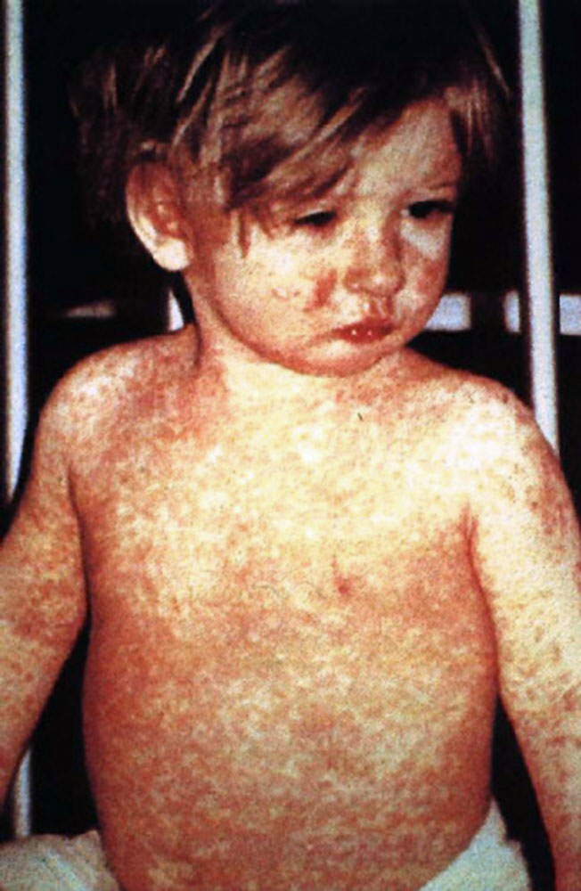 Measles Comeback: What You Need to Know